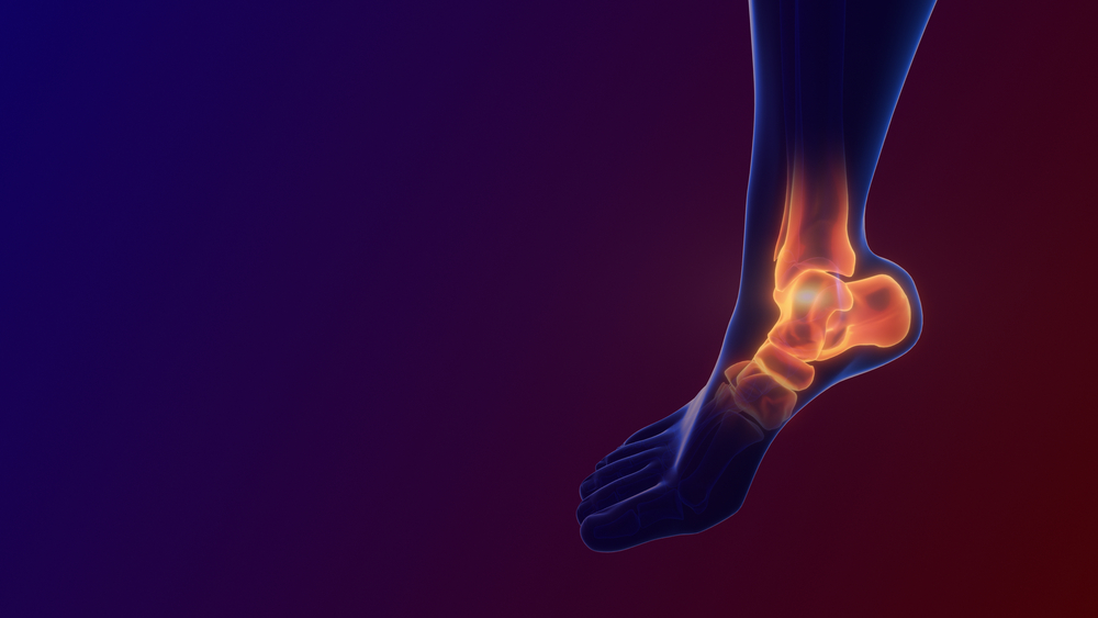 Holy Name Physician Performs Total Ankle Replacement Using 3D Printed Bone. Mybergen.com
